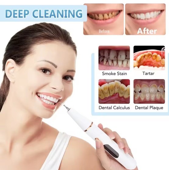Smart Ultra-Sonic Teeth Cleaner - Image 2